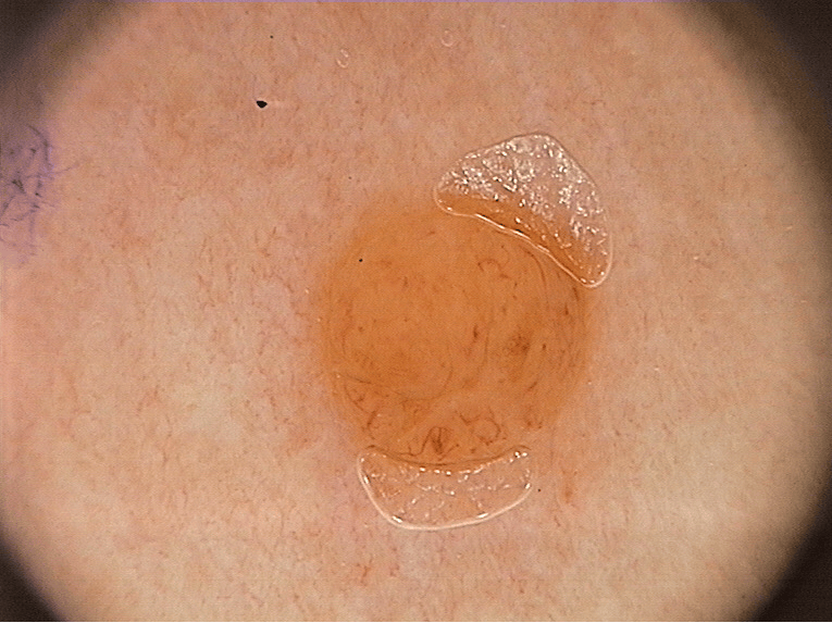 Mole Image 1