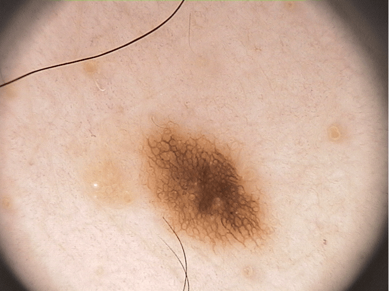 Mole Image 2