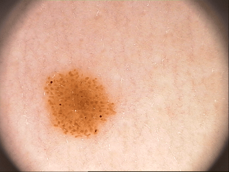 Mole Image 4